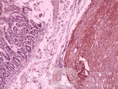 Jejunal Gastrointestinal Stromal tumor (GIST) (13 of 86)