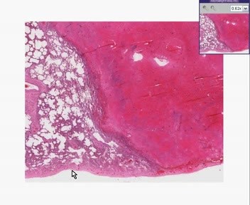 Lung - Recent Infarct