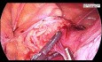Total Laparoscopic Hysterectomy for Very Large Uterus with Huge Fibroid