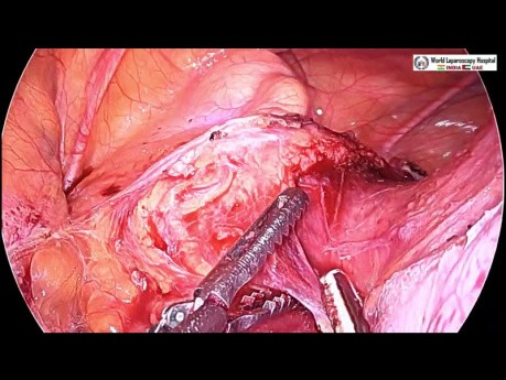 Total Laparoscopic Hysterectomy for Very Large Uterus with Huge Fibroid