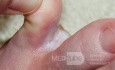 Interdigital Tinea pedis