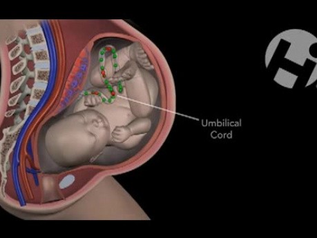 Baby Position and Amniotomy