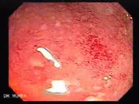 Colitis Ulcerosa - Pseudopolyps (1 of 22)