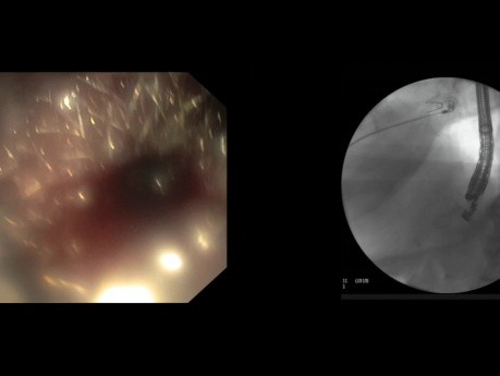 Pancreatic Gastrostomy
