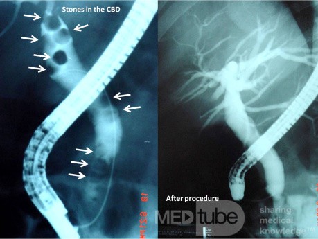 Multiple Stones in the Common Bile Duct