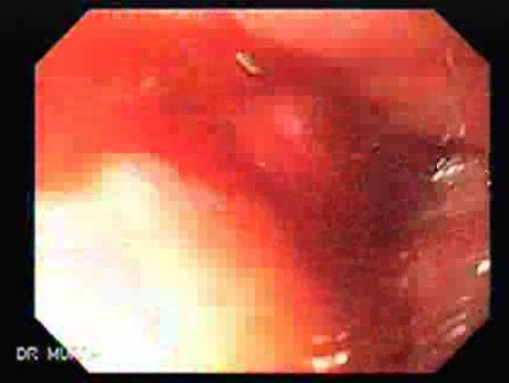 Adenocarcinoma of the Middle Third of Esophagus - Visualization of a Small Nodule in the Upper Third of the Esophagus