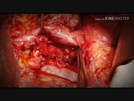 Anomaly of the Common Hepatic Artery Arising from the Superior Mesenteric Artery