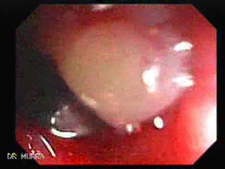 Status Post Rubber Band Ligation for Internal Hemorrhoids (4 of 7)