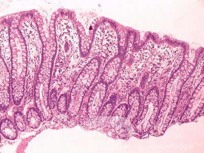There are chronic inflammatory changes and macrophages.
 10x.