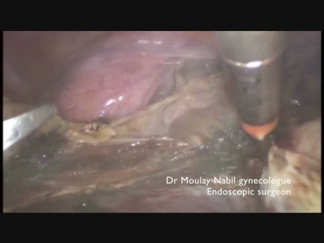 Supracervical Hysterectomy + In Bag Morcellation 