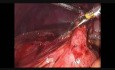 Laparoscopic Appendicectomy