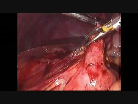 Laparoscopic Appendicectomy