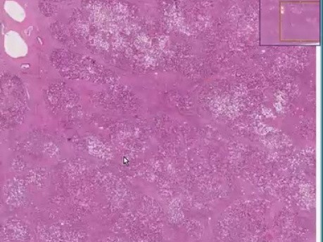 Cirrhosis (micronodular)