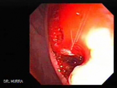 Abdominal Compartment Syndrome due to Malignancy (6 of 10)