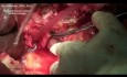 Whipple procedure (pancreatoduodenectomy) on complicated patient