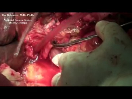 Whipple procedure (pancreatoduodenectomy) on complicated patient