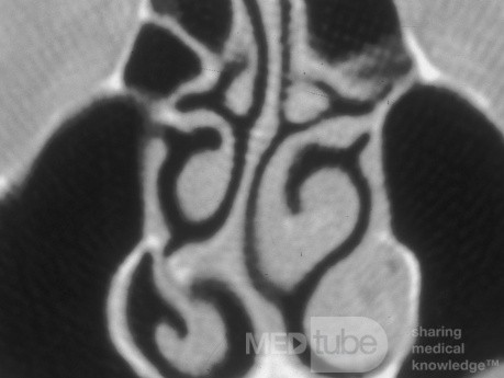 Nasal Septal Spur – CT Scan