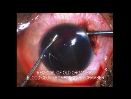 Management of Traumatic Hyphema with Vitrectomy Probe