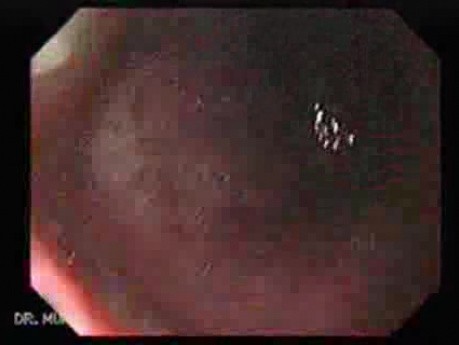 Gastric Cicatrization With Pylorus Stenosis (19 of 23)