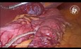 Giant Liver Hemangioma as an Incidentaloma in a Case of Sleeve Gastrectomy