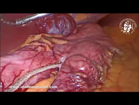 Giant Liver Hemangioma as an Incidentaloma in a Case of Sleeve Gastrectomy