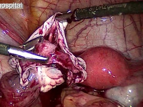 Treatment for Dermoid Cyst - Cystectomy Performed By Laparoscopic Method