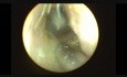 Endoscopic Myringotomy and Grommet Insertion Under Local Anesthesia