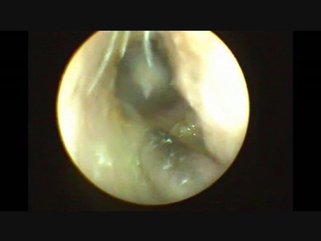 Endoscopic Myringotomy and Grommet Insertion Under Local Anesthesia