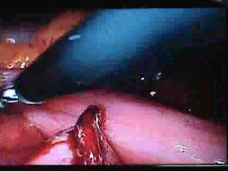 Jejunal Gastrointestinal Stromal tumor (GIST) (39 of 86)