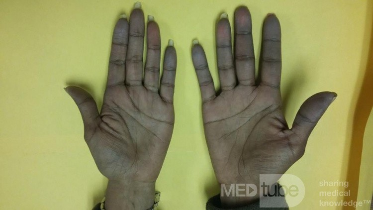 Raynaud's Phenomenon