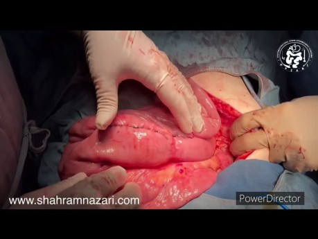 Jejunojejunal Intussusception