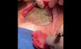 Chest Wall Reconstruction Post Trauma With Titanium Mesh Applied 
