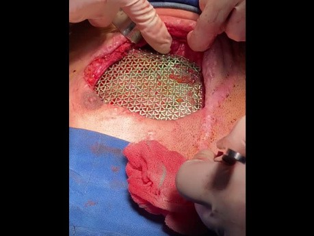 Chest Wall Reconstruction Post Trauma With Titanium Mesh Applied 