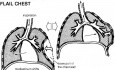The Mechanism of Flail Chest