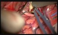 Microsurgical Clipping of the Right MCA Giant Aneurysm