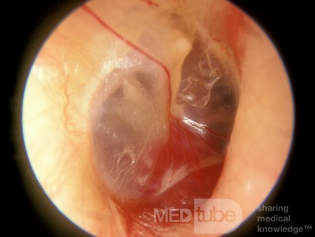 Glomus Tympanicum Right Middle Ear