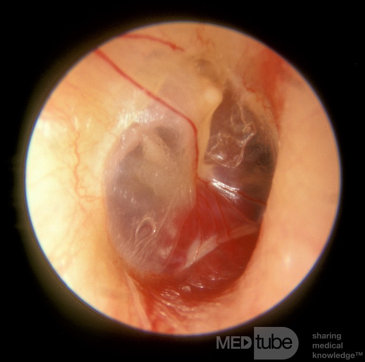 Glomus Tympanicum Right Middle Ear