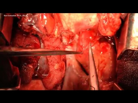 Surgery For Extragonadal Germ Cell Tumor Of Mediastinum 