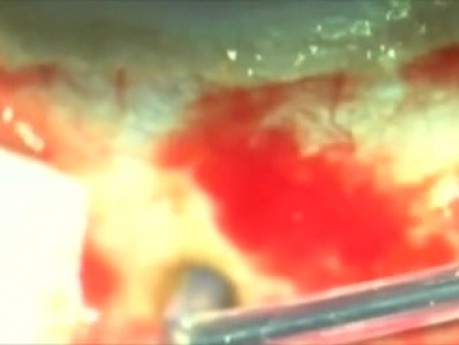 Glaucoma - Plasma Ablation Surgery