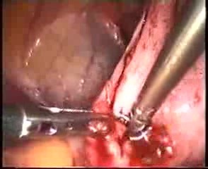 Laparoscopic Management Of Deep Endometriosis