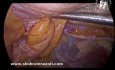 Pantaloon Hernia Laparoscopic Surgery