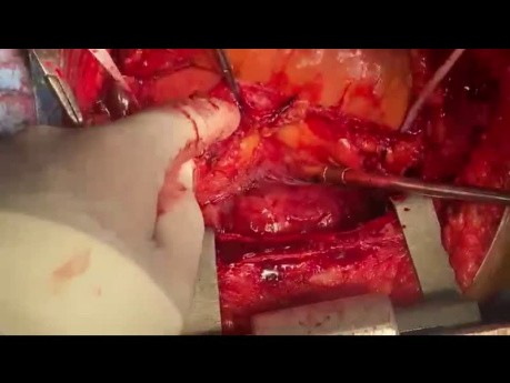 Right Hemithorax Sarcoma