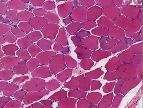 Muscular dystrophy