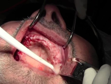 Implant Surgery, #5-6-7-8, 10-11-12-13 Sites