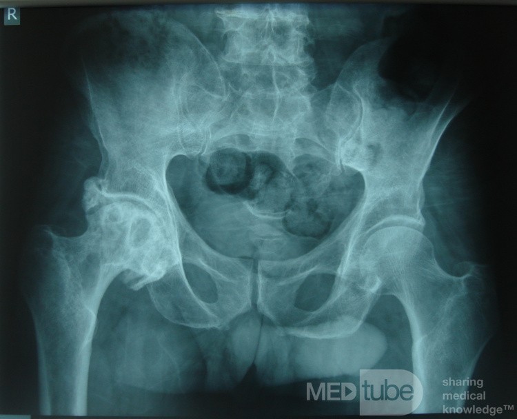 Sever OA of Rt. hip