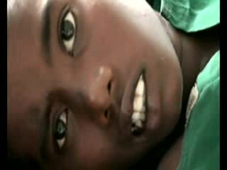 Cholesteatoma Complications