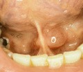 Mucous Cyst Floor of Mouth