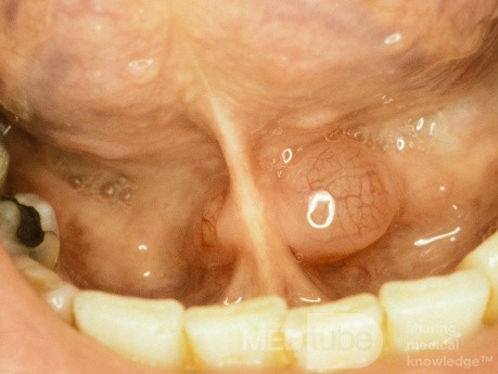 Mucous Cyst Floor of Mouth