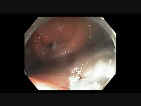 Transverse colon - EMR of a refractory polyp
