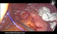 Laparoscopic Nissen Fundoplication